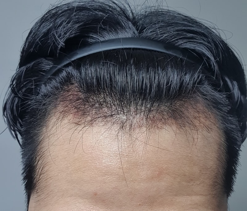 다나 엠자 무삭발 이식 곧 한달차 후기