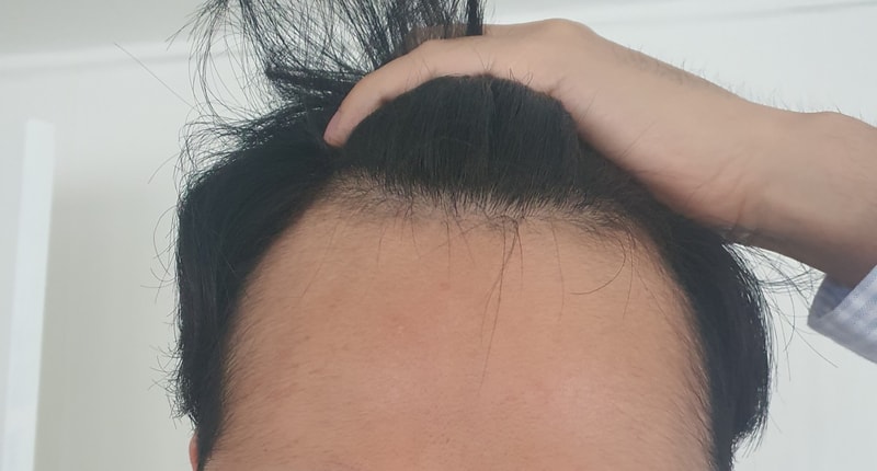 다나 무삭발 엠자 모발이식 3개월 후기