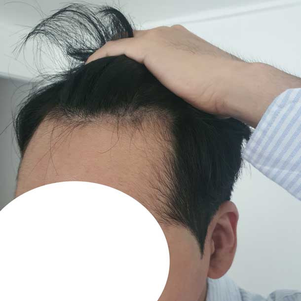 모발이식전엠자어쩔.jpg