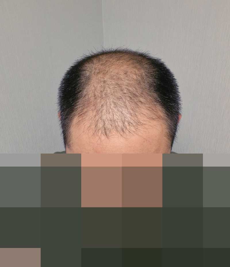 수술전의나.안습.jpg