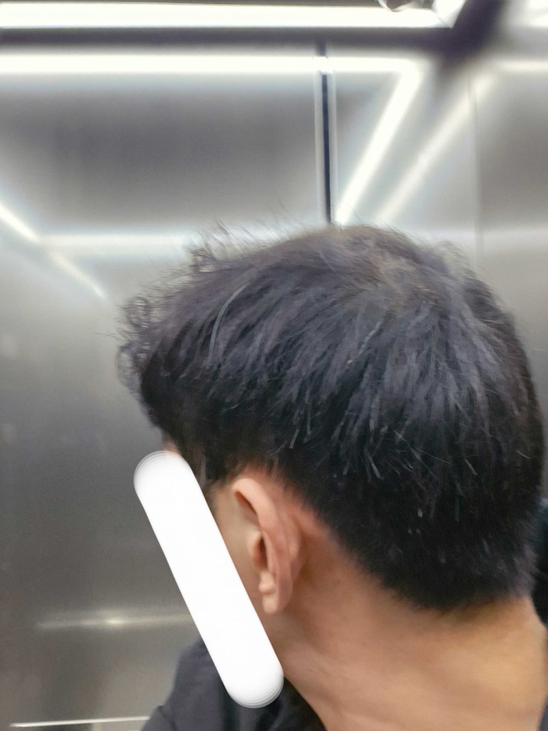 모발이식수술하고옆모습.jpg