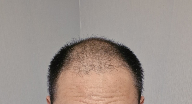 앞머리~정수리 전까지 심었어요. 다나에서 하고 3개월입니다