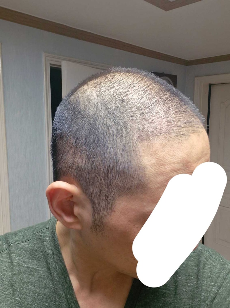 신사역탈모병원 다나에서 대량수술 16개월차