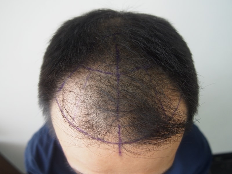 Non-cut 2500 hair follicles 4 months after photo