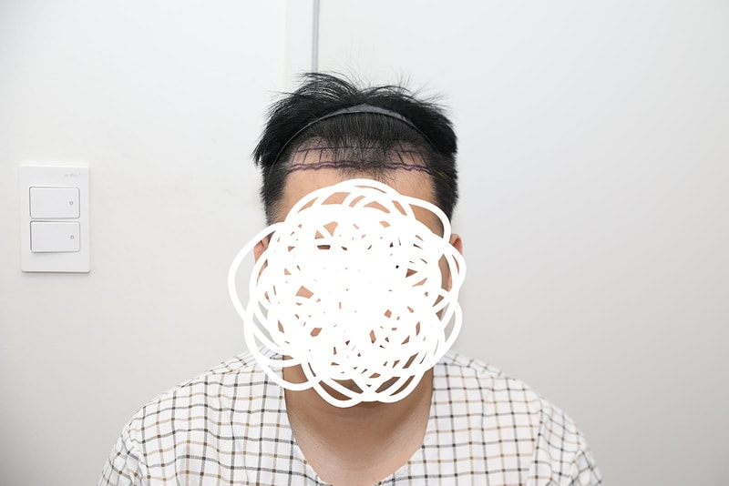 뉴헤어 모발이식 비절개 3821모낭 3개월차 후기