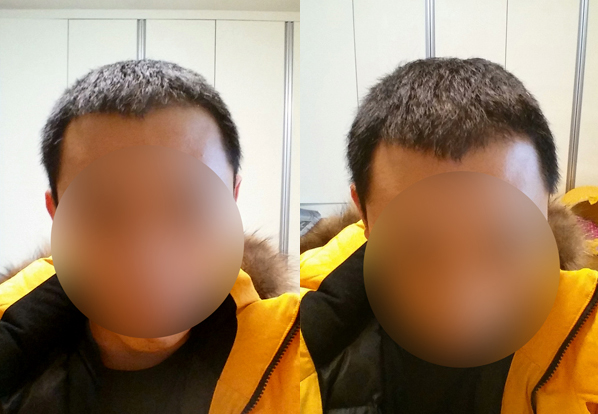 다나성형외과에서 대량이식 4개월! 이제 전체적으로 머리가 나네요^^