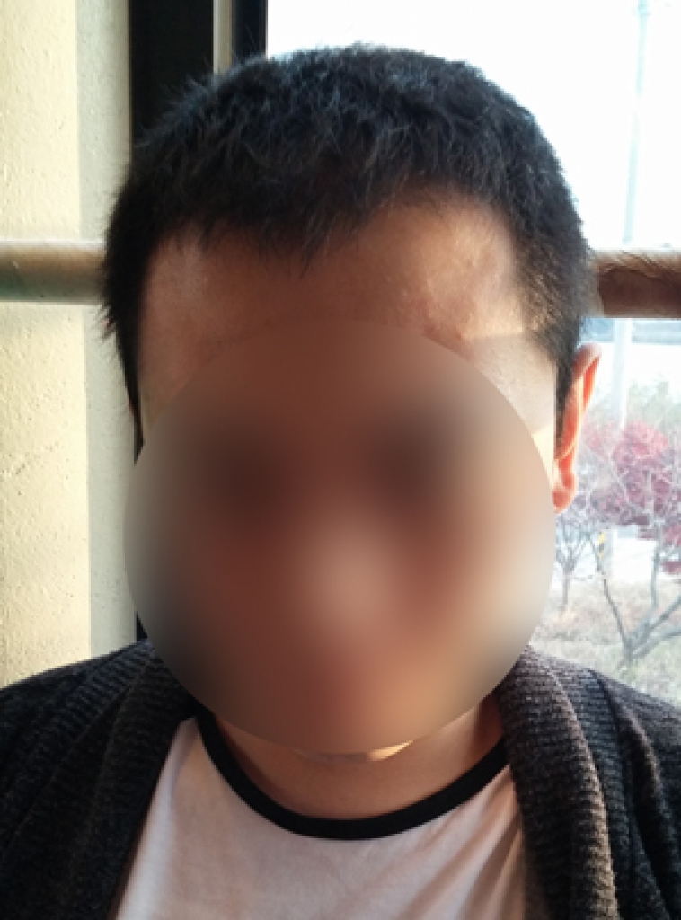 대량이식~다나성형외과에서 세달째! 수술 잘된거 같아요..ㅋ