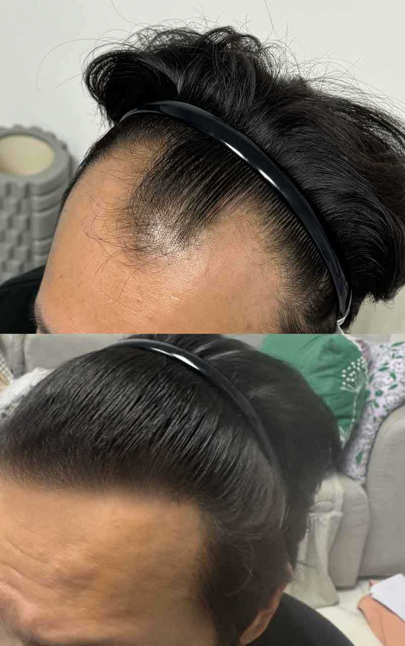 다나성형외과 비절개모발이식 9개월