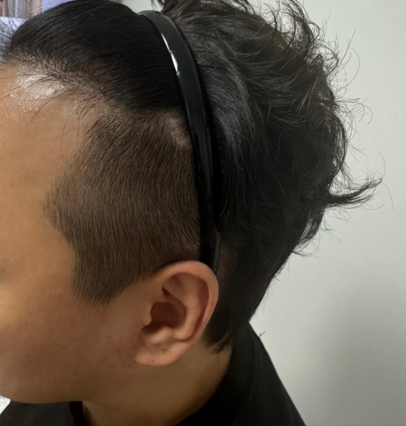 비절개모발이식_M자라인_15개월후.jpg