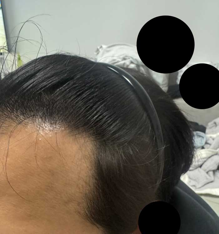 다나성형외과 비절개모발이식 8개월간 일어난 변화