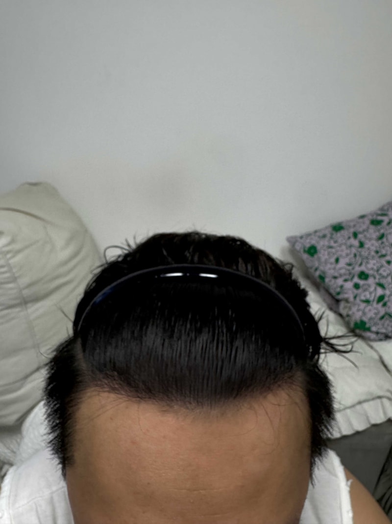 다나성형외과 3400모 비절개 16개월차 후기