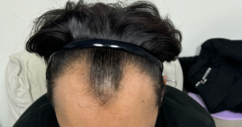 다나성형외과 깊은 엠자 이식 1일 후기