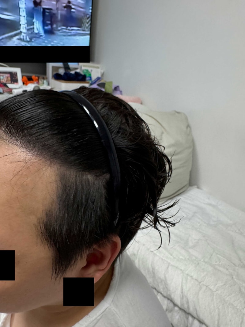비절개모발이식16개월2.jpg