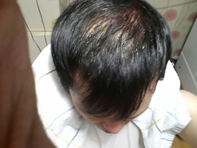 2)수술당일셀카 (2).jpg