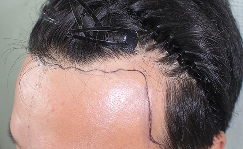유 광현_20160407_모발_18645.jpg