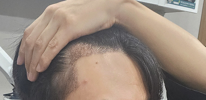 4- 잘심어졌으니 잘빠지고 다시 잘자라주길 지문샴푸받고 많이 더 빠진 느낌.jpg