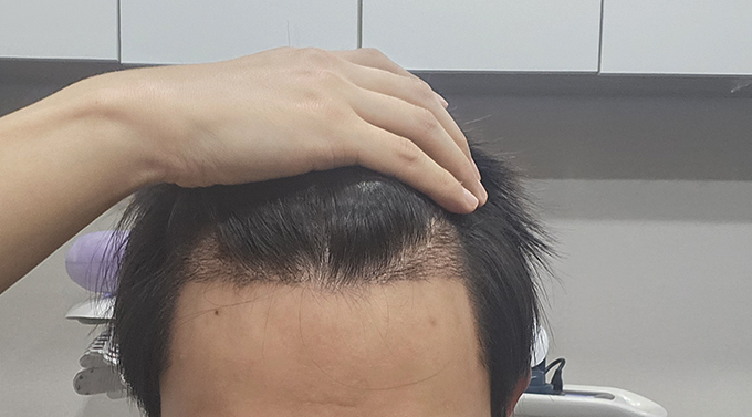 2- 금일 10시 2주샴푸 받고 찍어봤습니 지문샴푸 빡빡해주시고 레이저받았어요.jpg