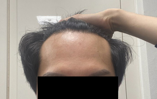 모플러스 성형외과 모발이식 후기!
