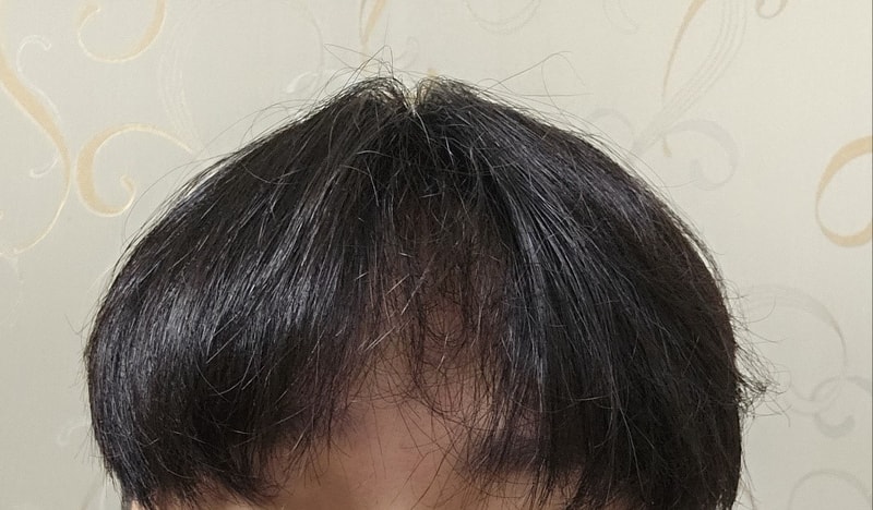 다나 엠자 삭제된 11개월 후기