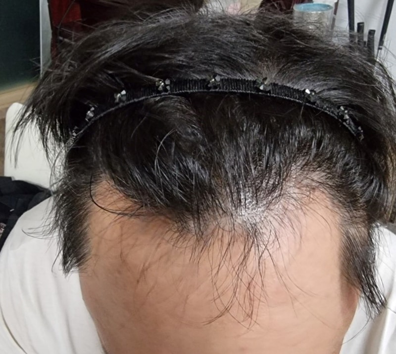 다나 엠자 수술 13개월 후기입니다