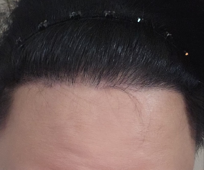 다나 엠자 9개월 경과 후기