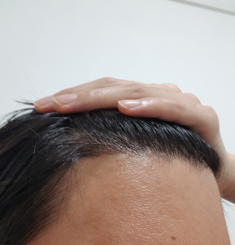 05.오준태_수술6달.jpg
