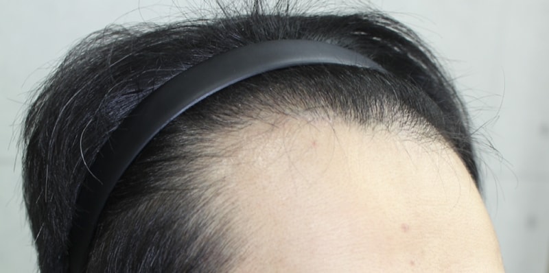 이식전 (2).png