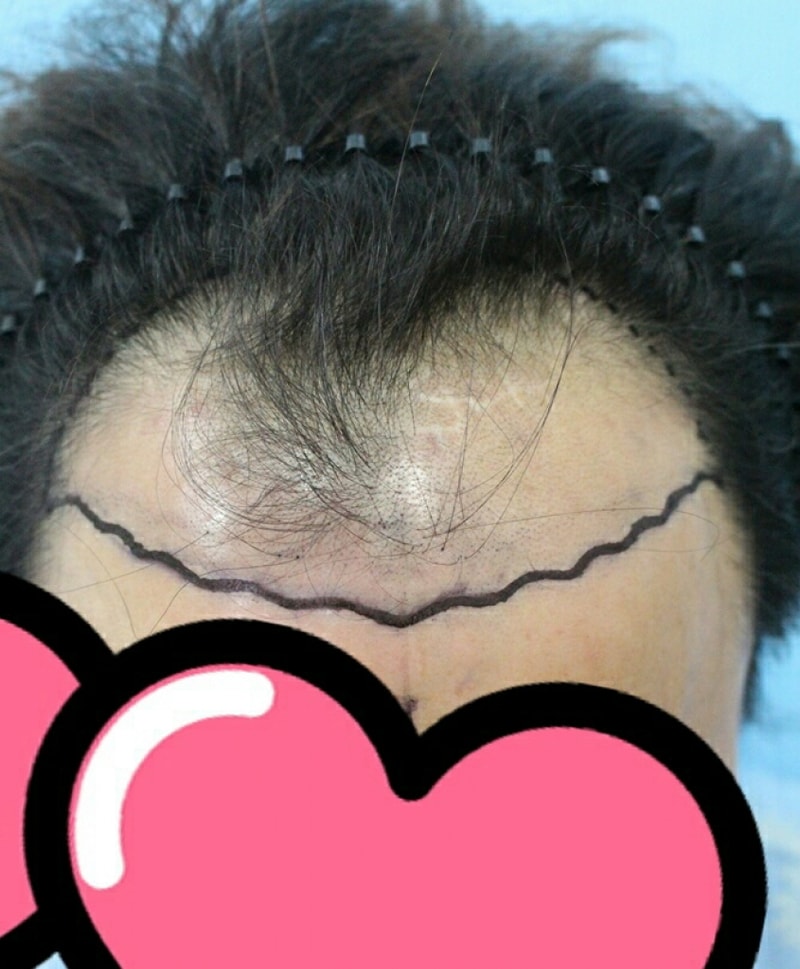절개 3000모 6개월차 입니다 봐주세요~