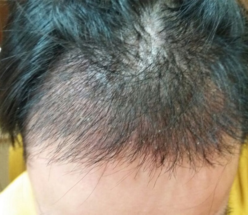 수술 2주차.jpg