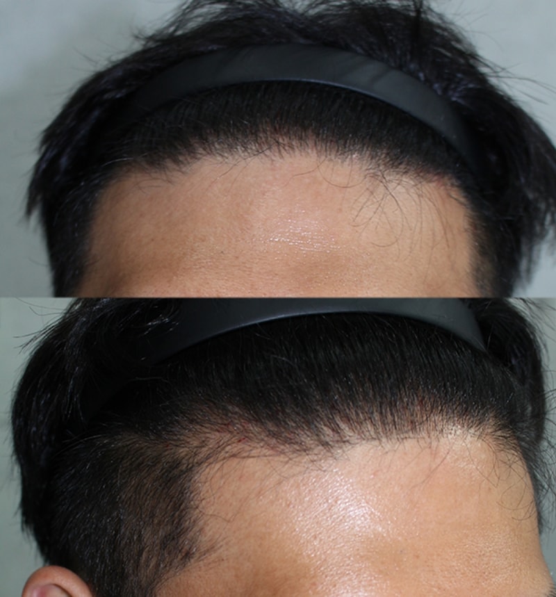 수술7개월후.png