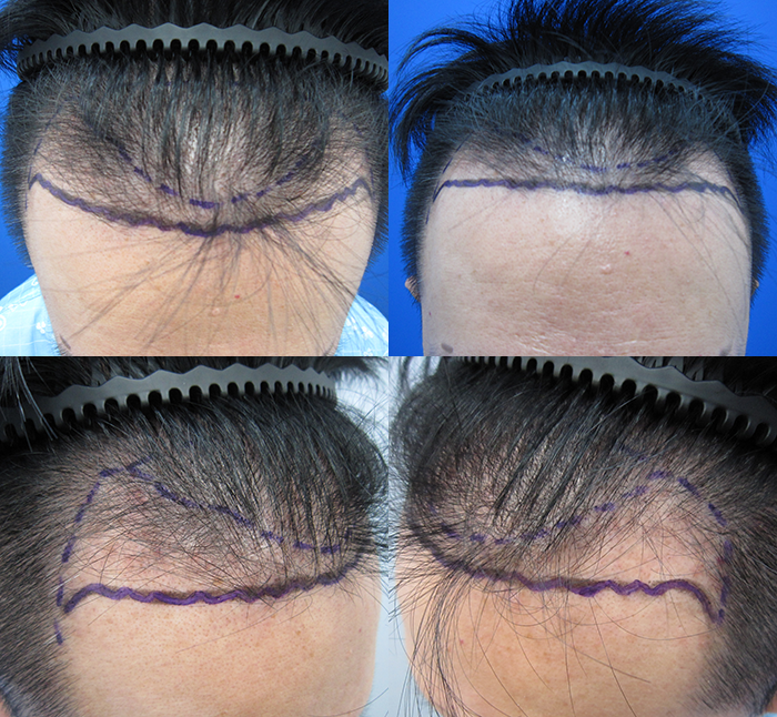 한나이브 비절개 3300모 모발이식 1년 최종 득모 후기