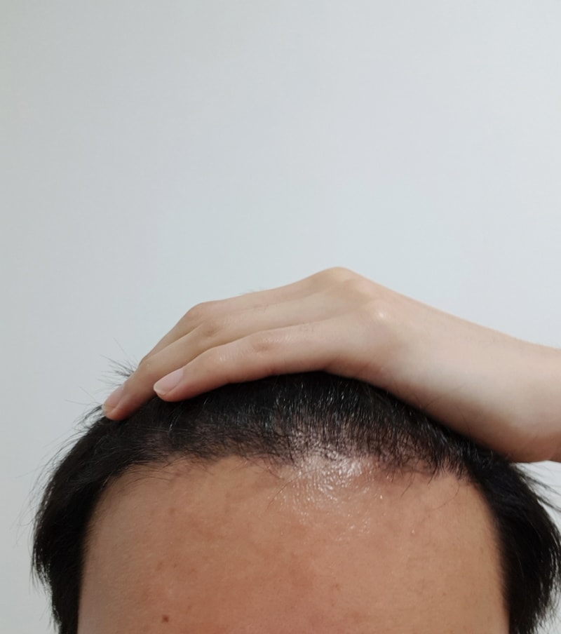 02.오준태_수술5달.jpg