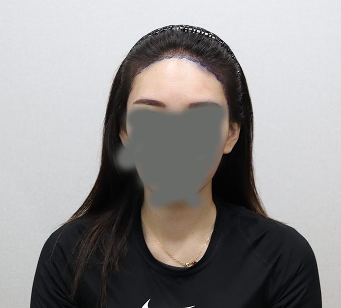 수술후1.jpg