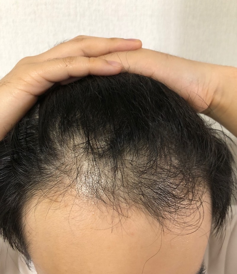 다나 무삭발 이식 후 1년 자축. 앞 머리 내린 사진도 있어요