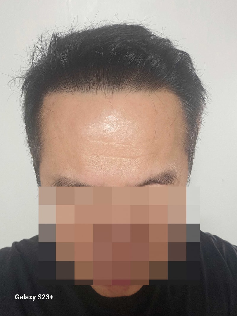 주위에 추천하는 병원! 다나성형외과 대량탈모 대량이식 6000모 16개월입니다~~ ^^