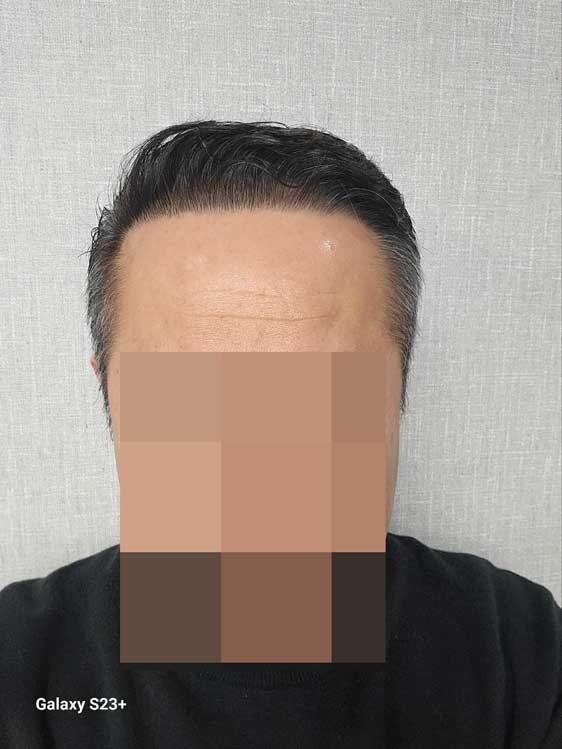 다나성형외과 비절개모발이식 6000모 10달~~~