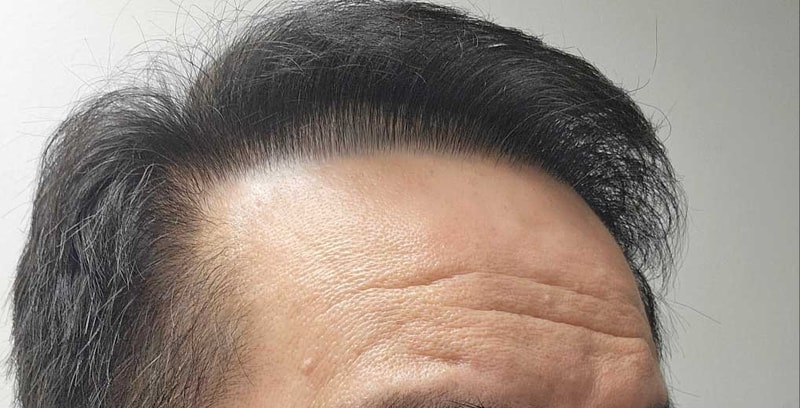 다나성형외과 3000모낭 대량이식 8달 후기^^