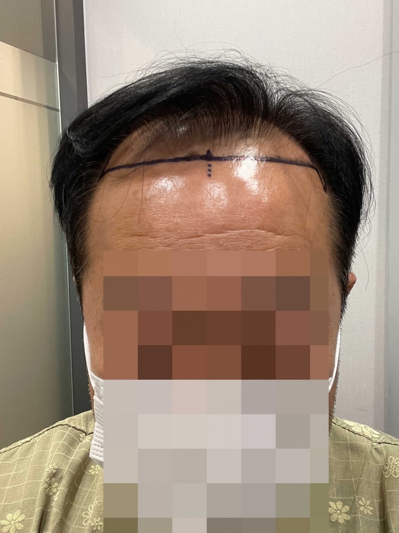 다나성형외과 대량이식 17개월입니다 ~^^ 이병원을 자신있게 추천하는이유~?