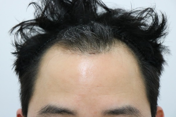 절개 9개월 경과 평가해주세요