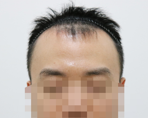 남성형탈모 진단받고 모발이식했습니다