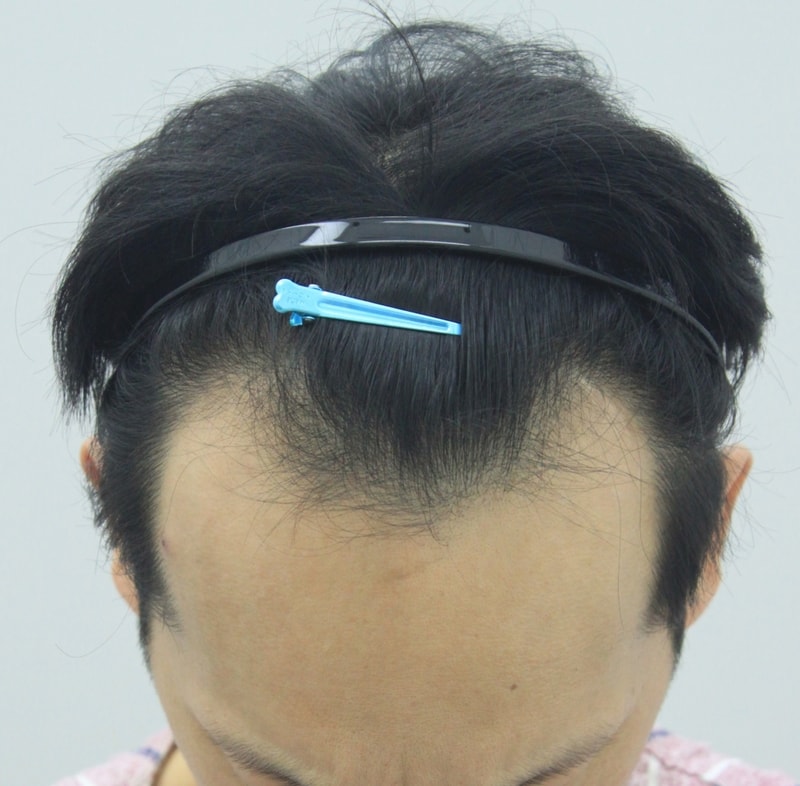 포헤어 1300모낭 1년차 경험담