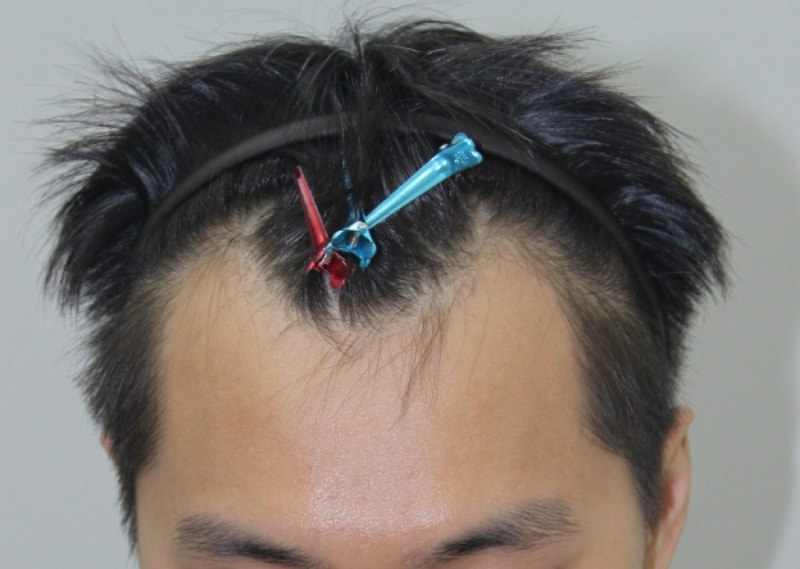 크기변환_수술전_정면.jpg