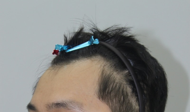 크기변환_수술전_좌.jpg