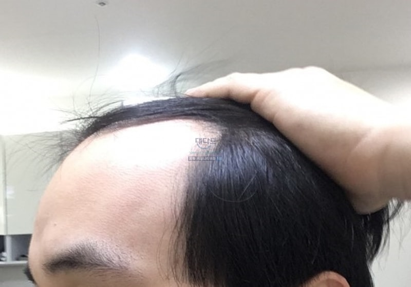 M자 탈모 1300모낭 비절개 포헤어 경과보고