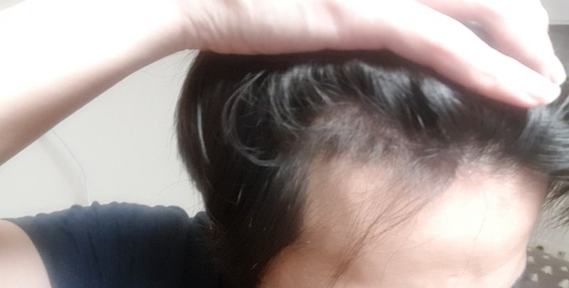 다나 무삭발수술 1달이에요