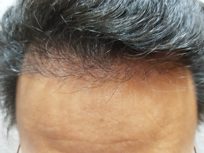 모재성 비절개 1400모낭 4개월차 후기입니다.