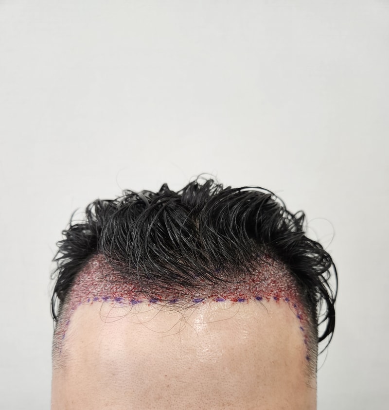 Review on the day of non-intersection of the parent plastic surgery surgery