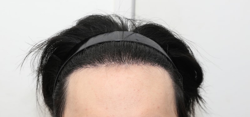 NEWHAiR 植发中心切开1000毛囊，第180天坦率后记