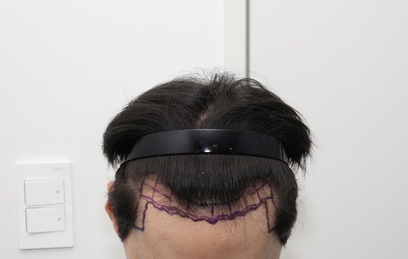 뉴헤어 서울점 비절개 모발이식 1700모낭 9개월차 후기