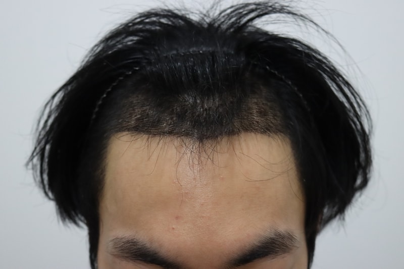 모엠의원 절개 모발이식 2주 후 모습입니다